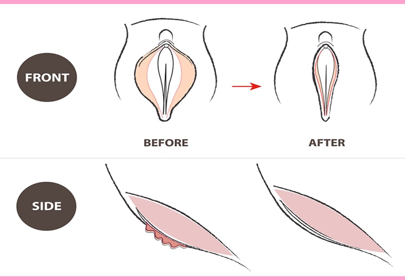 Vaginoplasty in Indore